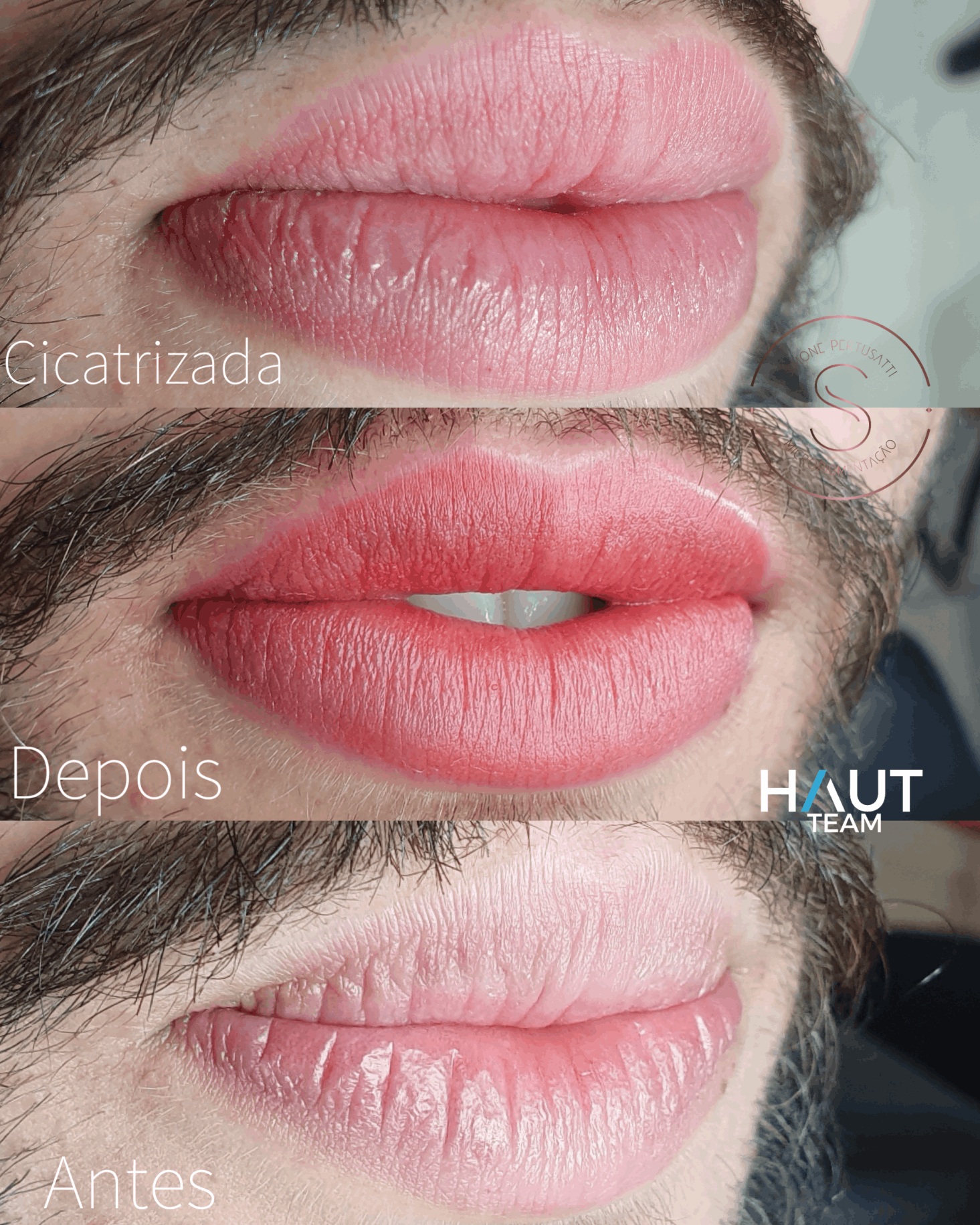 exemplo antes e depois micropigmentacao de labios em curitiba