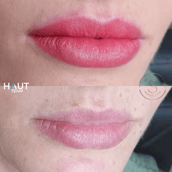 exemplo antes e depois micropigmentacao de labios em curitiba